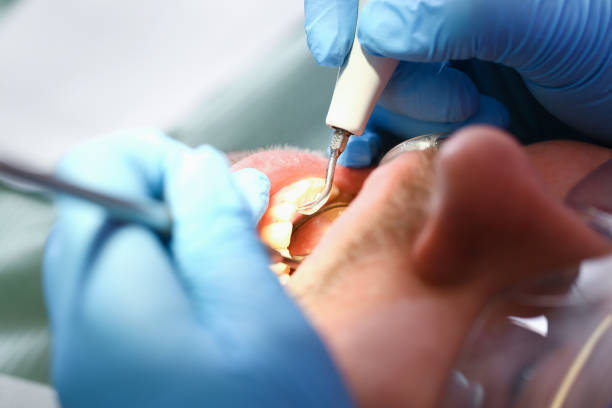Best Knocked-Out Tooth (Avulsed Tooth) Treatment in Edinboro, PA